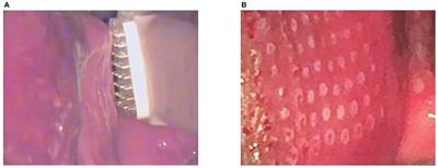 Microablative Fractional Radiofrequency as a Therapeutical Option for Genitourinary Syndrome of Menopause: Perspectives